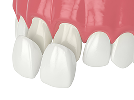 Addison Dental Studio | Ceramic Crowns, Digital Impressions and Dental Cleanings