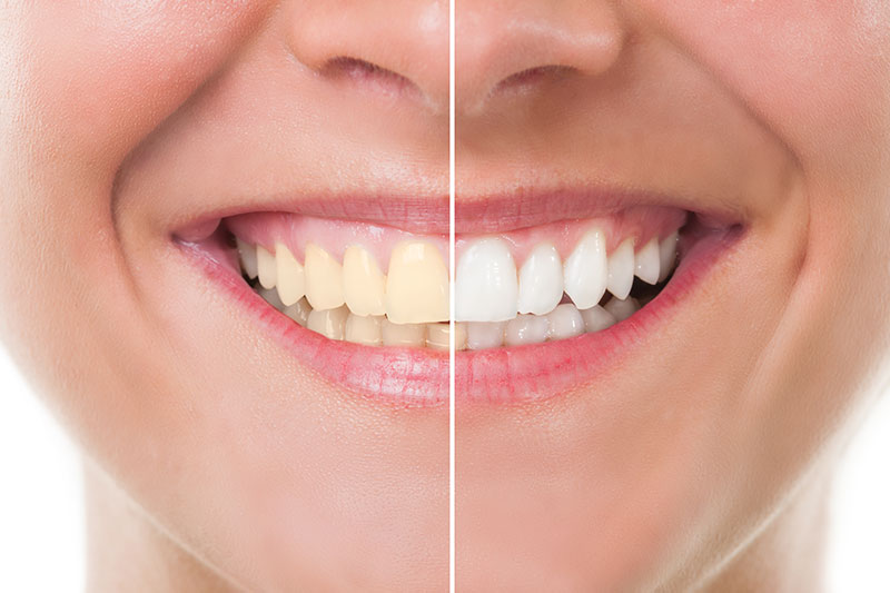 Teeth Whitening in Addison