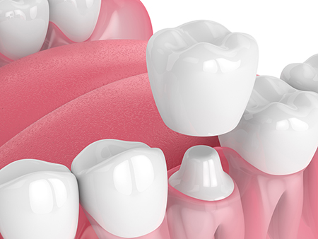 Addison Dental Studio | Sedation Dentistry, Dental Fillings and Crowns amp Caps