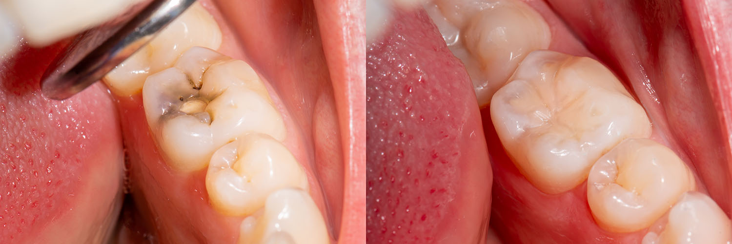 Addison Dental Studio | Digital Impressions, Teeth Whitening and Intraoral Camera